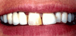 Dental Bridges Manassas Dentists
